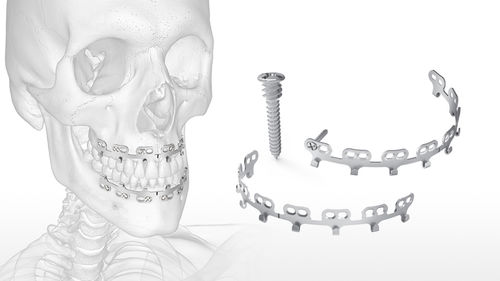 Distrator mandibular - QuickFix™ MMF - Acumed - externo