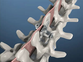 Implante vertebral interespinhoso lombar - PITBULL® - BM Korea - sacral / torácico
