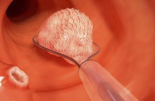 Pinça para endoscopia - Captiva® - G-FLEX Europe - para remoção