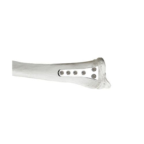 Placa de compressão óssea para rádio - 37.800 series - Medicalex - distal / bloqueada / metálica