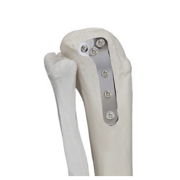 Placa de compressão óssea para tíbia - 37.803 series - Medicalex - proximal / lateral / não bloqueada