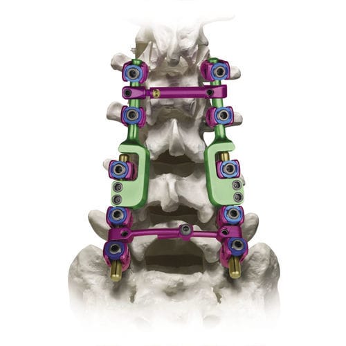 Sistema de osteossíntese lombossacral - REVERE® ADDITION® - Globus Medical - via posterior