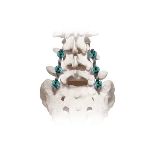 Sistema de osteossíntese lombossacral - CREO® 5.5  - Globus Medical - via posterior
