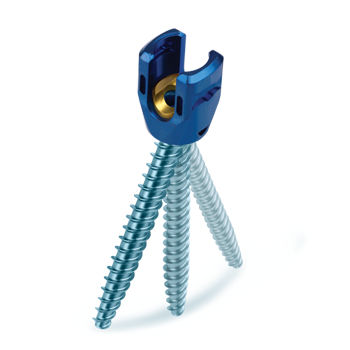 Parafuso pedicular para vértebra de transição lombossacra - REVERE® Uniplanar - Globus Medical - poliaxial / metálico