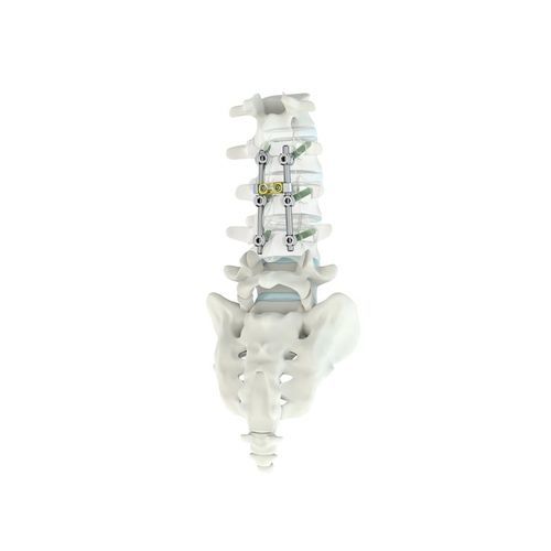 Sistema de osteossíntese toracolombar - M.U.S.T.® MC - Medacta - via posterior