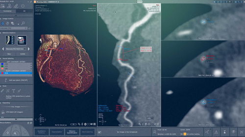 Módulo de software de cardiologia - Myrian® XP-Cardiac - Intrasense - de análise / de visualização / de planejamento