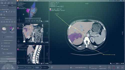 Módulo de software de análise - Myrian® XP-Liver - Intrasense - de planejamento / de simulação 3D / para radiologia