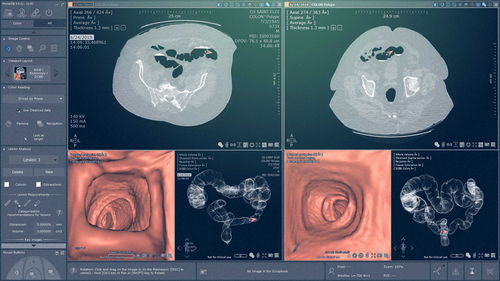 Módulo de software de análise - Myrian® XP-Colon - Intrasense - de visualização / de avaliação / para oncologia