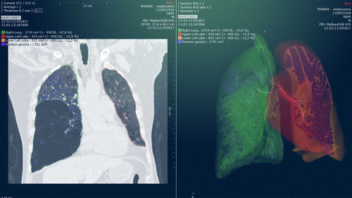 Módulo de software de análise - Myrian® XP-Lung - Intrasense - de planejamento / de simulação / para radiologia