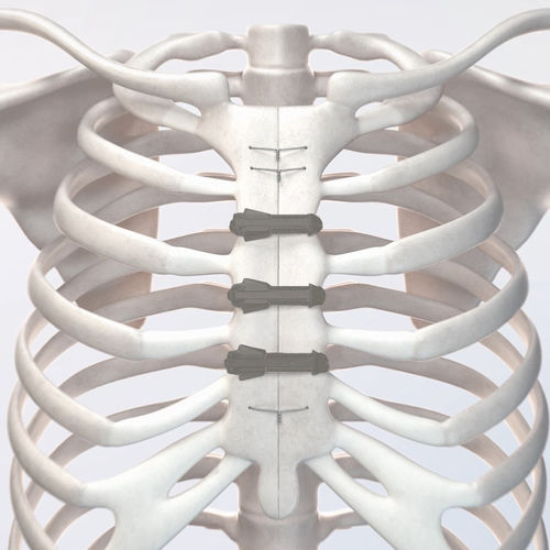 Fio de cerclagem óssea para fechamento do esterno - STERN™ FIX - NEOS Surgery - monofilamentar polimérico