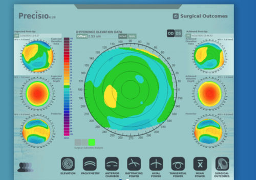 Software de análise - iVerify® - iVis Technologies - de verificação / médico-hospitalar / para cirurgia oftalmológica