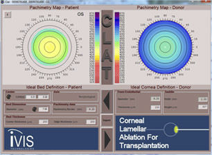 Software de planejamento - CLAT® - iVis Technologies - de design / médico-hospitalar / para cirurgia oftalmológica