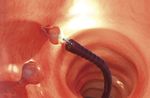 cesta extratora de pólipos intestinais