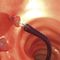 cesta extratora de pólipos intestinaisSensor®G-FLEX Europe