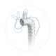 stent-enxerto para arco aórtico / em nitinol / em polietileno