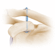 botão de sutura para reconstrução do ligamento acromioclavicular